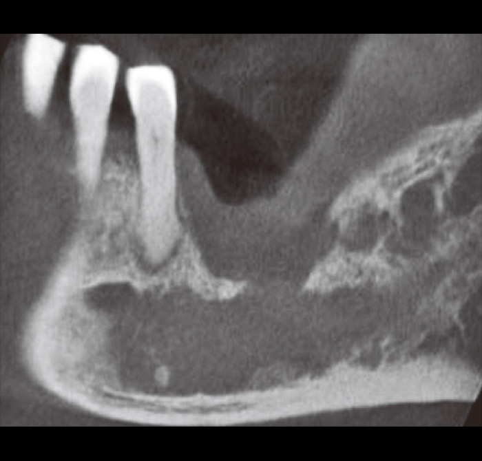 症例2-3 保存不可能と診断し抜歯したが下顎管まで到達する骨欠損が確認できる。