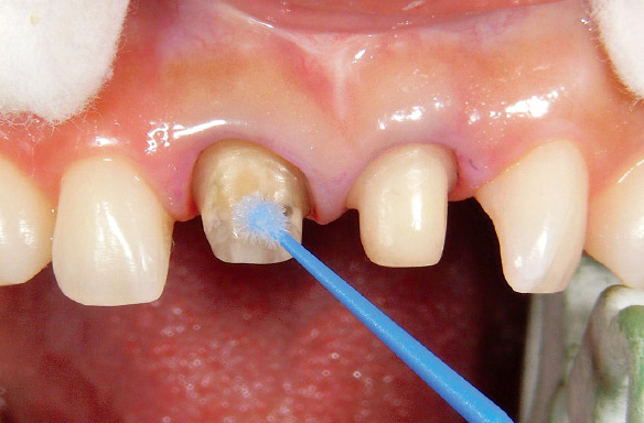 図19 トゥースプライマーを用いて支台歯にも接着前処理を行った。