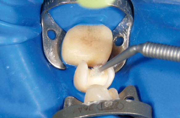図13 防湿と歯肉圧排を目的にラバーダムを装着した。その後トゥースプライマーを用いて支台歯にも接着前処理を行った。