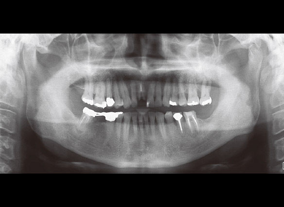 図7-1 初診時（2008年6月）のパノラマＸ線写真。