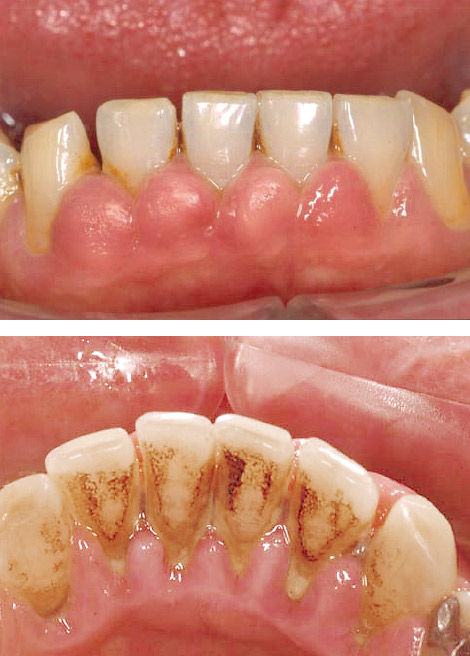 図1 重度歯周炎。歯肉の異常な腫脹がみられる（2002年10月）。