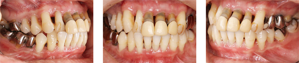 図9 初診時（2013年5月）の歯周病の急性発作後、歯ブラシ指導、歯肉縁上のプラーク除去で症状が落ちついた状態（2013年8月）。