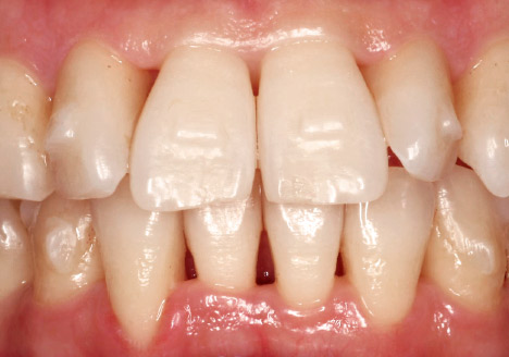 症例2-5 ディスキングから2ヵ月後の口腔内。経過途中だが叢生の改善が見られる。