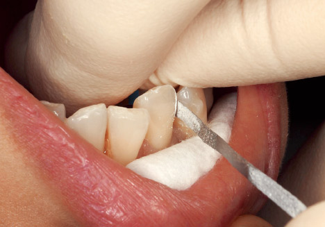 症例1-4 下顎叢生部の2回目のディスキング時。「コース」はメッシュ状に小さな穴が開いているため、この状態でも目詰まりは起こしていない。