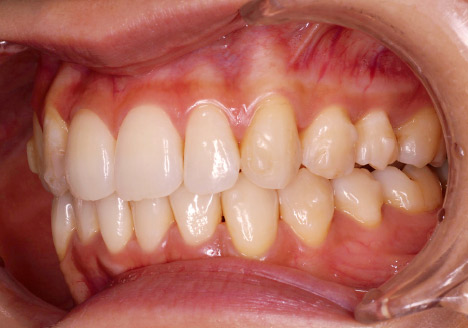 症例1-5 最初のディスキングから3ヵ月後の口腔内。経過途中だが叢生の改善が見られる。