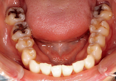 症例1-6 最初のディスキングから3ヵ月後の口腔内。