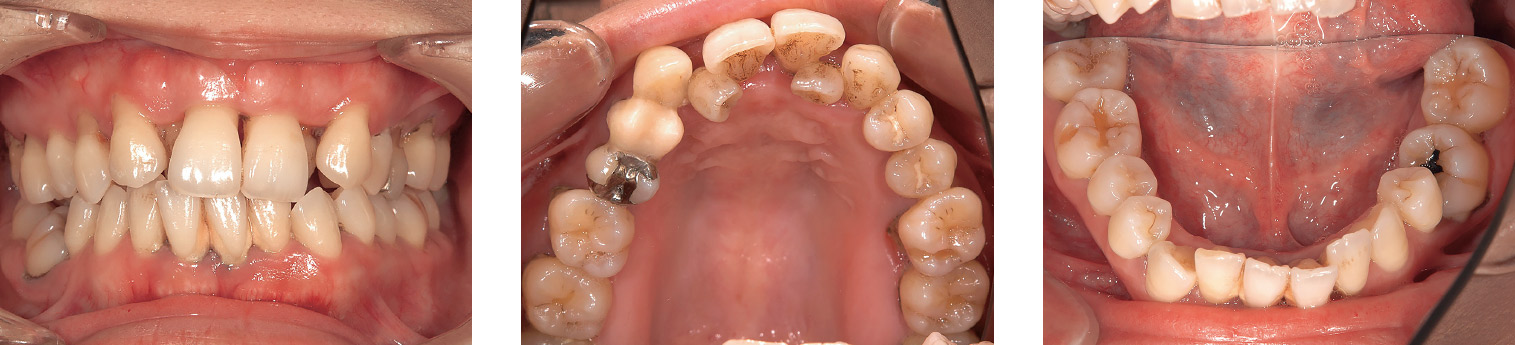 図4-1〜3 初診時（2011年4月）の口腔内写真。