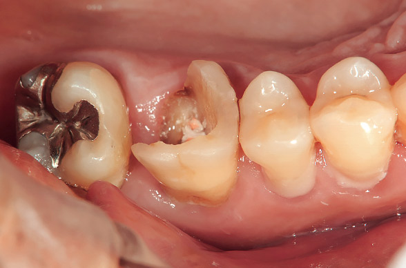図5 このように縁上歯質が残っているケースは、安易にレジンコアが選択されやすい。