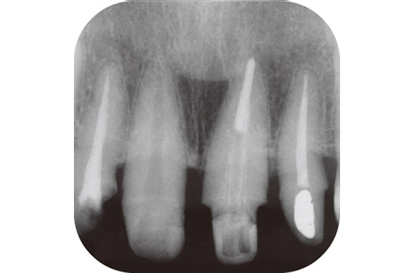 図19 同1 デンタルX線写真。