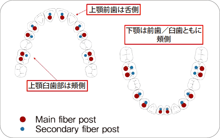 表1 理想的なファイバーポストの配置＜文献11）より改変・引用＞