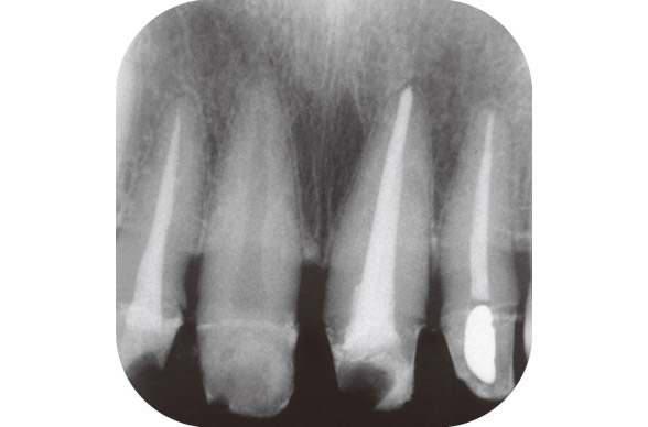 図11 2015年5月29日　根充後のX線写真　接着による封鎖が期待できるメタシールSoft（サンメディカル）にて根充を行った。