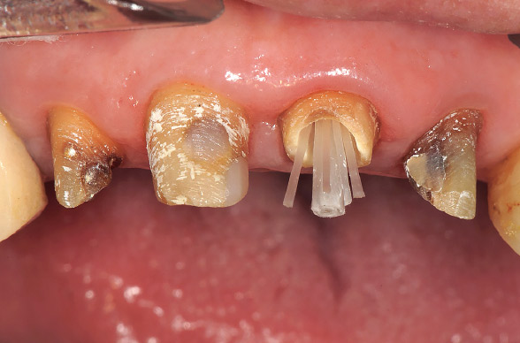 図13 試適時の正面観。やや漏斗状の根管形態であったため、光ファイバーポストをスリーブおよびアクセサリーファイバーで補強している。
