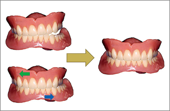図3 咬合採得の要件。適正な咬合採得では、咬合の不均衡や前後左右への咬頭嵌合位のズレが無い。
