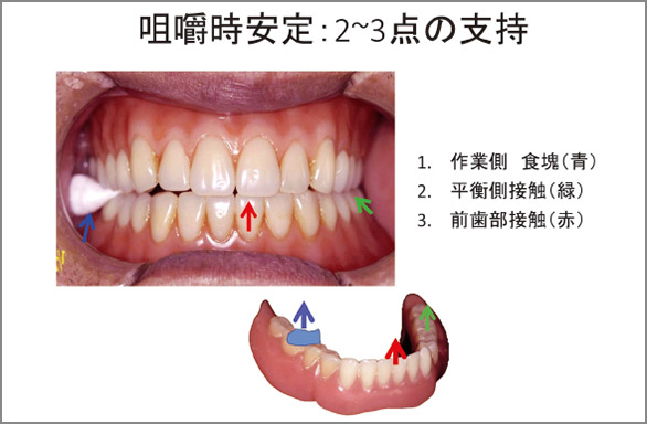 図4 人工歯排列では、義歯が動きにくいこと、動きをいち早く止めること、を両立する。