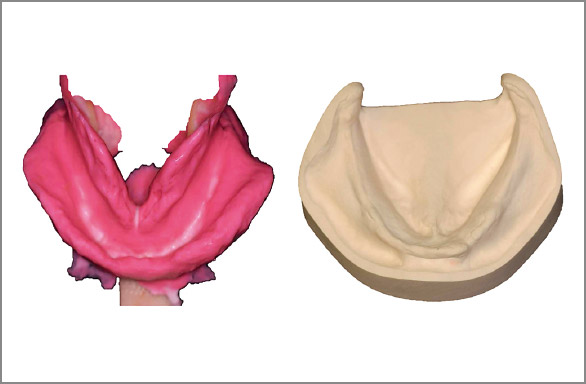 図7 採得された印象体と石膏模型。