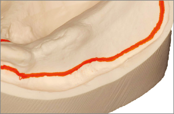 図9 頰側部。粘膜の折り返し位置より2mm程度短く、骨の外側縁上に設定する。