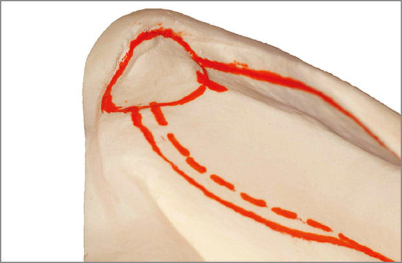 図11 顎舌骨筋線部。パッド中央より2mm後方から顎舌骨筋線部を2mm覆うように描記する。