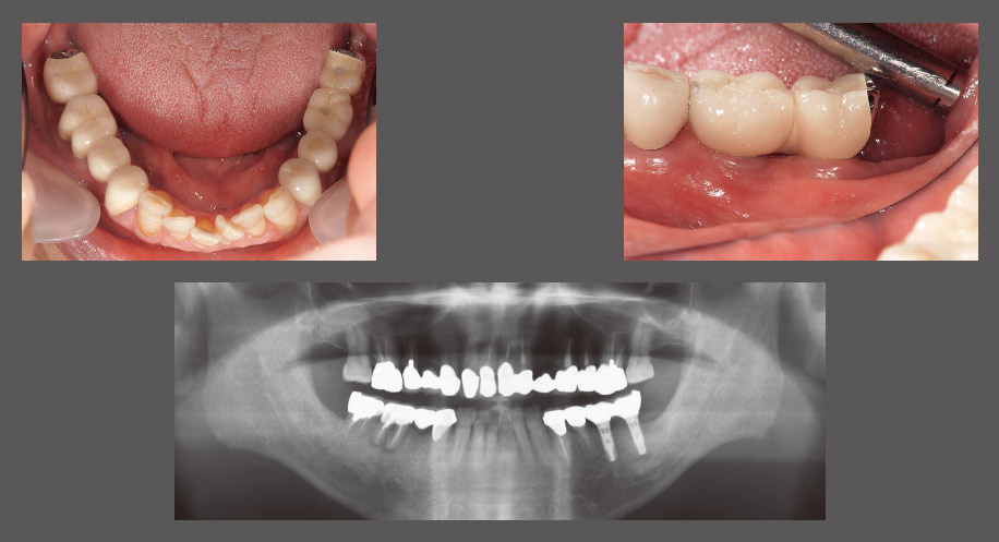 図14 最終補綴装着時の口腔内写真およびパノラマX線写真