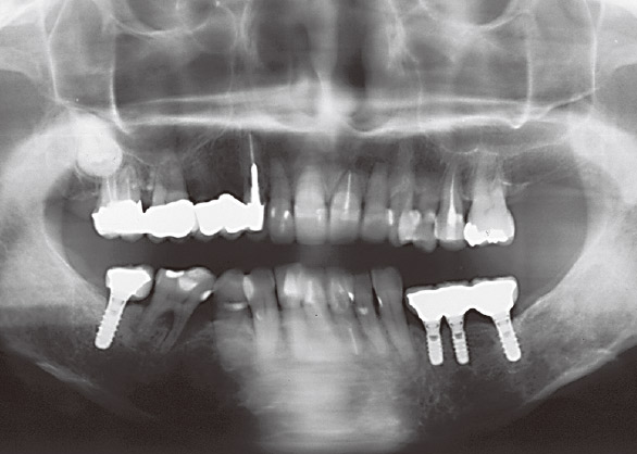 図1 症例1 58歳女性。#46の歯周病。