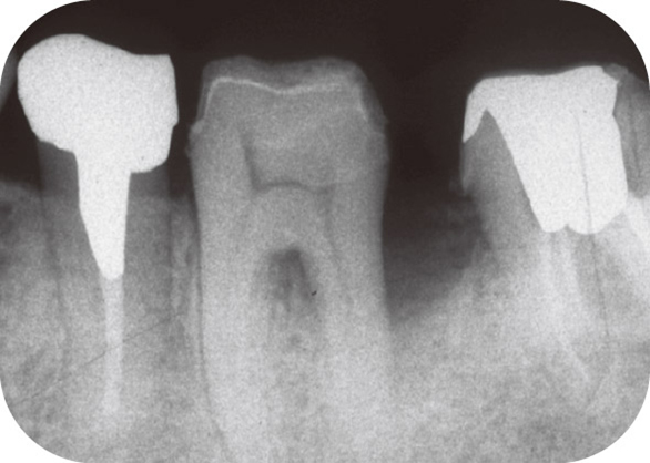図16 歯周外科後23日（1997年6月）。
