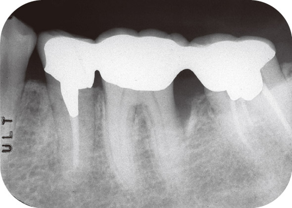 図18 術後9年。7mmの歯周ポケット（2006年9月）。