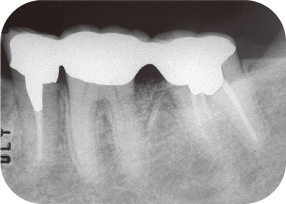 図19 7mmの歯周ポケットへHA移植手術（2006年11月）。