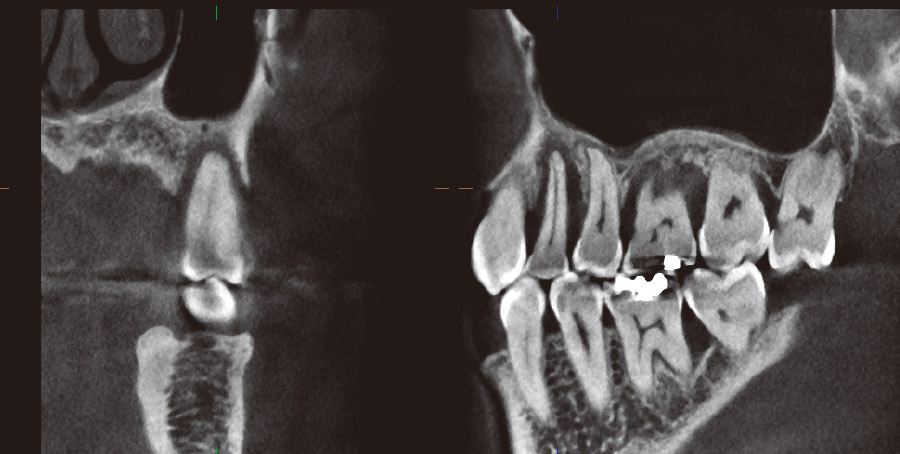 図25 症例5のCBCTで#24主体とした断面像
