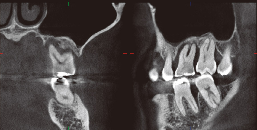 図26 症例5のCBCTで#26主体とした断面像。