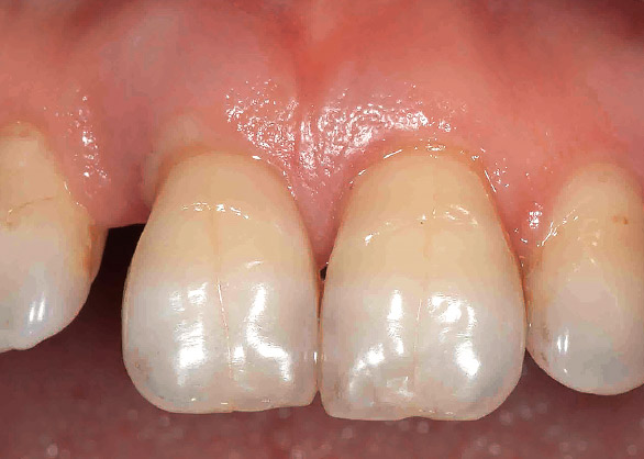 図3 症例2 43歳女性。#11と#21の歯周病。