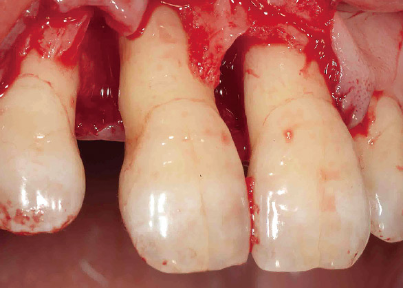 図5 症例2の歯周外科において歯肉溝切開にて歯肉を剥離した状態。