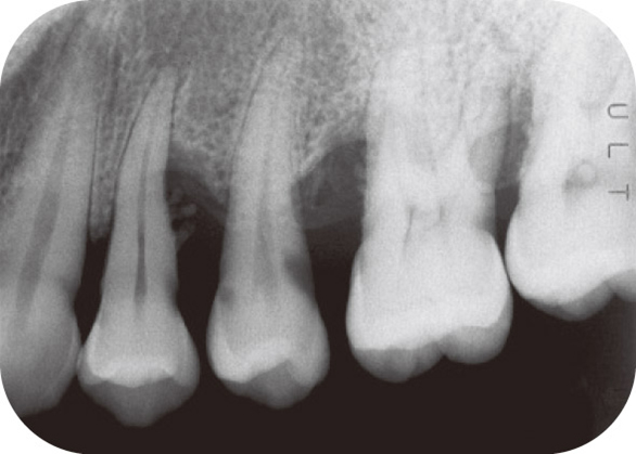 図7 術前デンタルX線写真。