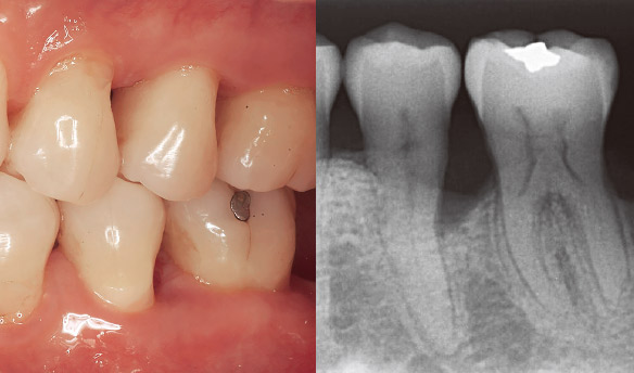 症例1-1 遠心には10mmの歯周ポケットと垂直性の骨欠損を認めた。