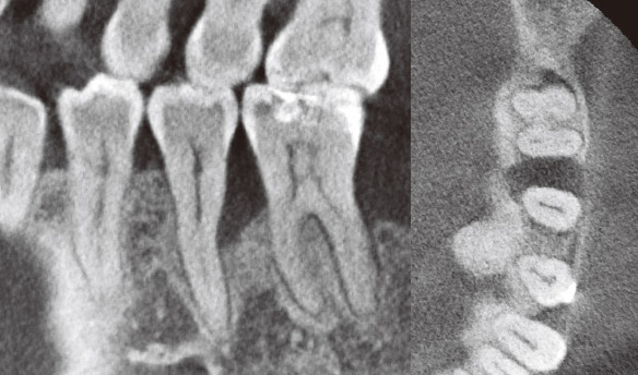 症例1-2 CT所見から骨欠損は頰舌的に広がる2壁から3壁の骨欠損であることがわかる。