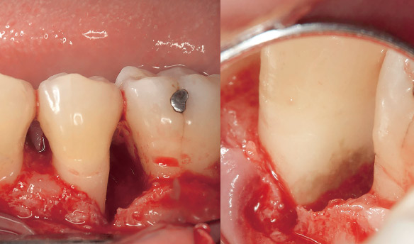 症例1-3 再生療法時、CT所見から推測した通りの骨欠損を認め、遠心には歯石の付着を認めた。