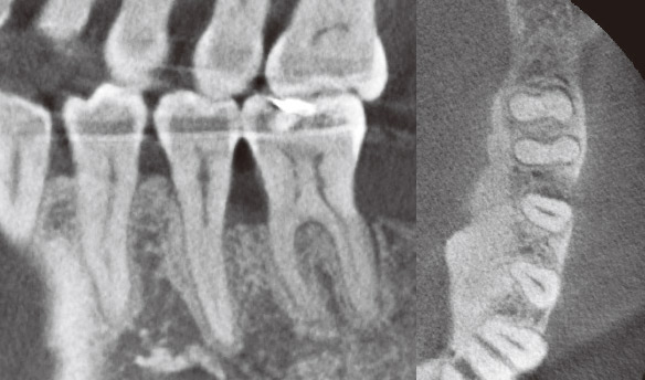 症例1-6 CT所見からも骨欠損の改善を認めた。