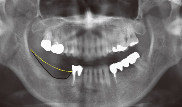 症例2-1 右下臼歯部の欠損部にインプラント治療を希望し来院された。欠損部には著しい顎堤の吸収を認めた。