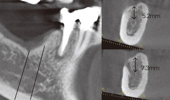 症例2-2 CT所見からインプラント治療を行うにあたり水平的垂直的なGBRが必要であると診断した。