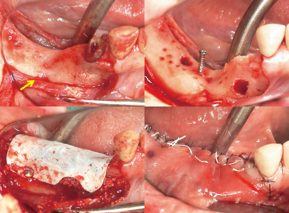 症例2-3 GBRはスクリューと骨移植材、非吸収性メンブレンを用いて行った。