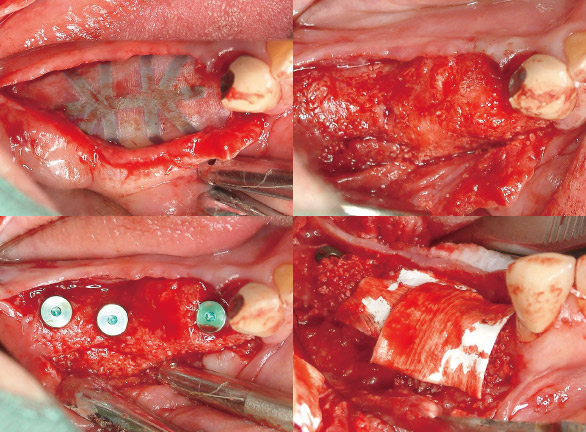 症例2-4 GBR後6ヵ月、予定の部位にインプラントを埋入し、同時にマイナーGBRを行った。
