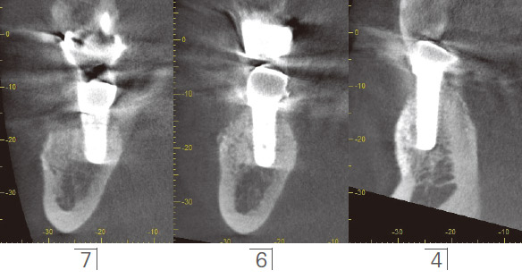 症例2-5 術後のCT所見ではインプラント周囲に十分な硬組織が獲得されている。
