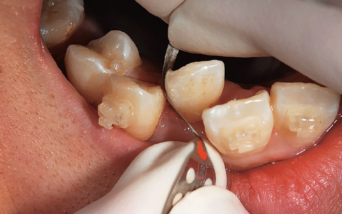 図1 歯科研削用ストリップを用いた矯正治療時のストリッピングの様子。入り組んだ歯列に対しても削合や研磨が可能。