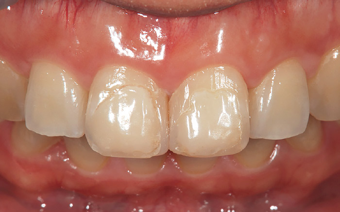 図3 症例1-1。30歳女性。主訴は上顎左右中切歯の審美障害。既存のCRおよびう蝕の除去後、PLVによる修復治療を行う。