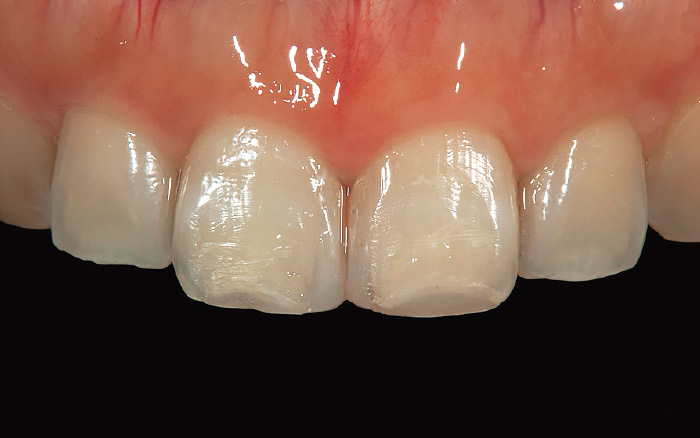 図4 症例1-2。旧充填物を除去して、患者さんの持つ本来の形態をCR充填にて再現する。この状態でシリコン印象を行い、削除量チェックのためのガイドとする。