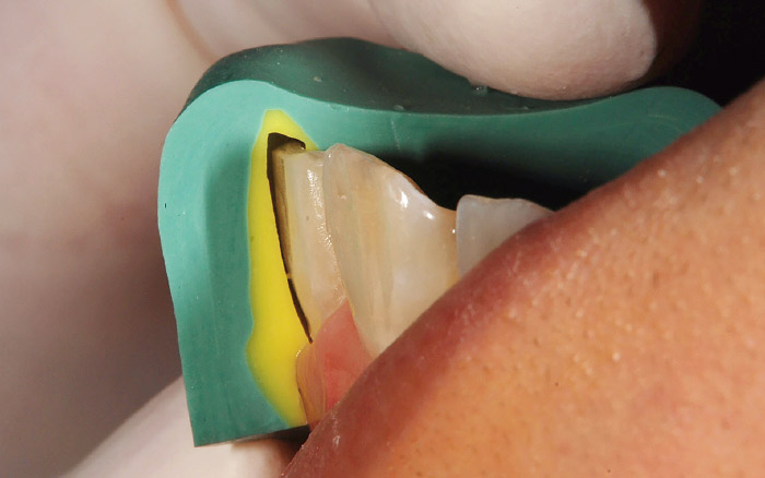 図5 症例1-3。シリコンガイドにて削除量を確認しながら支台歯形成する。エナメル質に限局するので無麻酔下での形成となる。0.2〜0.3mmの削除量を目指す。