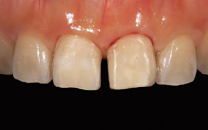 図6 症例1-4。支台歯形成終了時。もともと正中離開ということで、隣接面部においてはエナメル質内の形成でもこれだけ空隙が生じた。