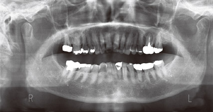 図1 初診時パノラマX線写真。