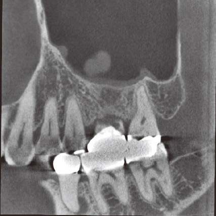 図3a 術後9ヵ月後のCBCT矢状断像。