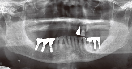 図7 初診時パノラマX線写真。