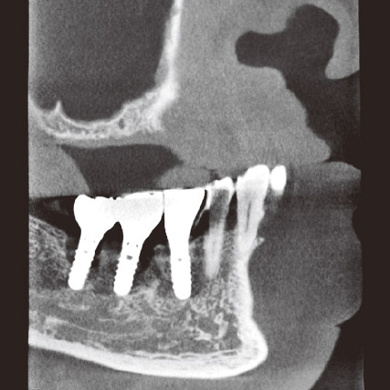図10a 初診時CBCT矢状断。765 部いずれも67 部ほどではないがインプラント周囲の骨吸収を認める。