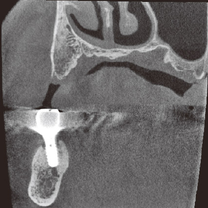 図10c CBCT前頭断。